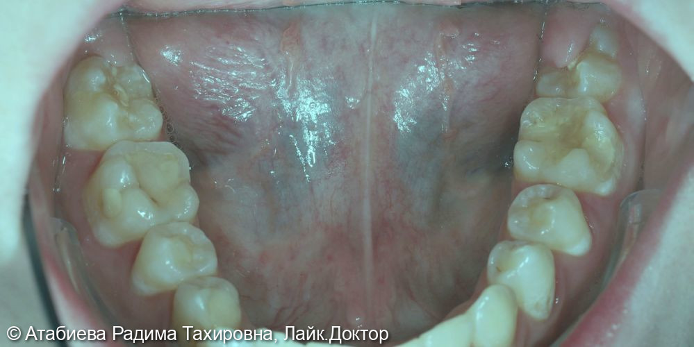 Лечение кариеса 3.6 и 4.6 зубов - фото №1