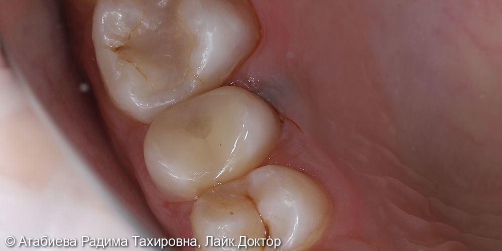 Восстановление зуба 1.5 на стекло-волоконном штифте - фото №3