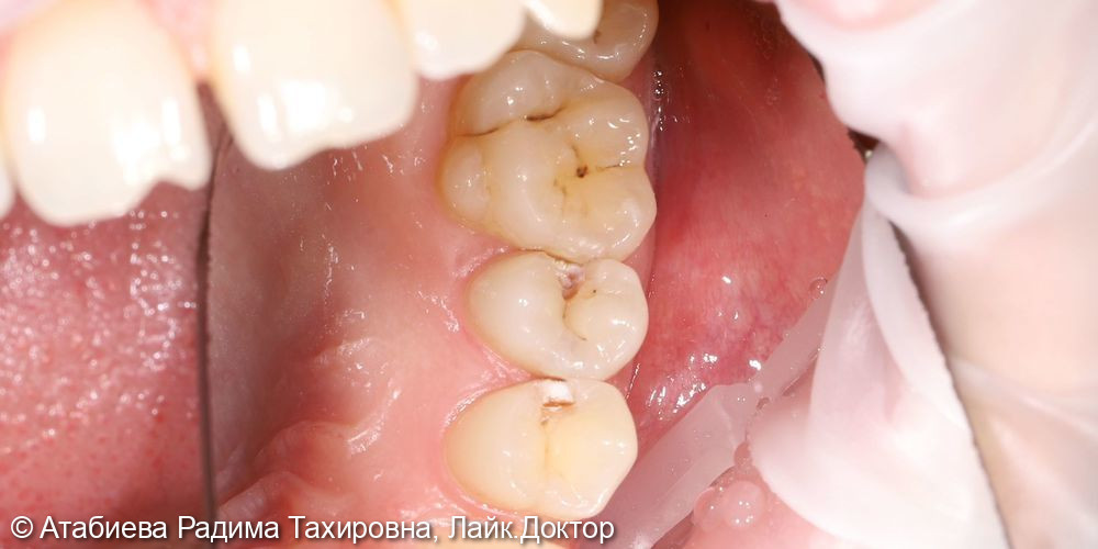 Лечение кариеса 2.4 + 2.5 - фото №1