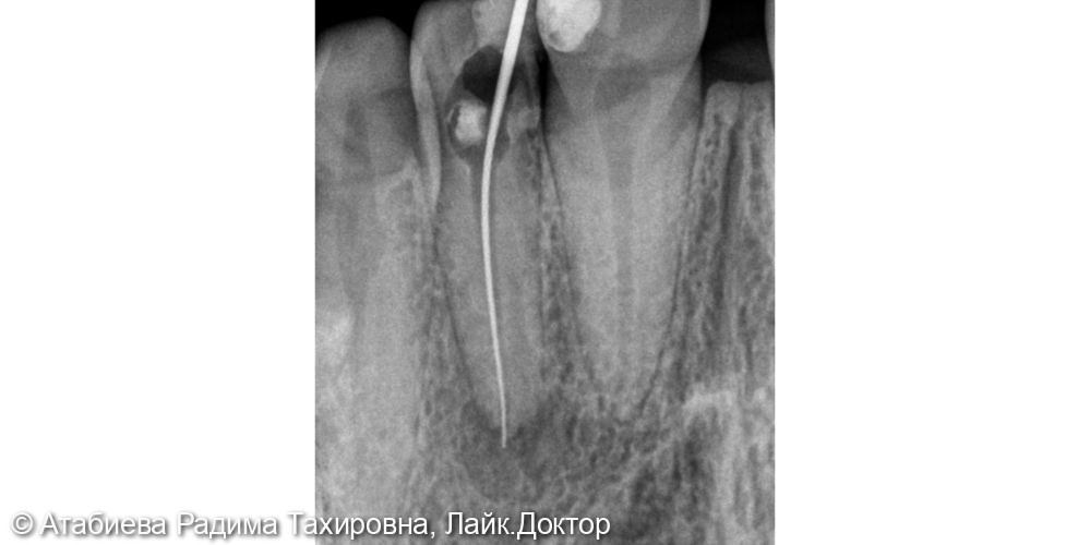 Эндодонтическое лечение 2.2 - фото №2