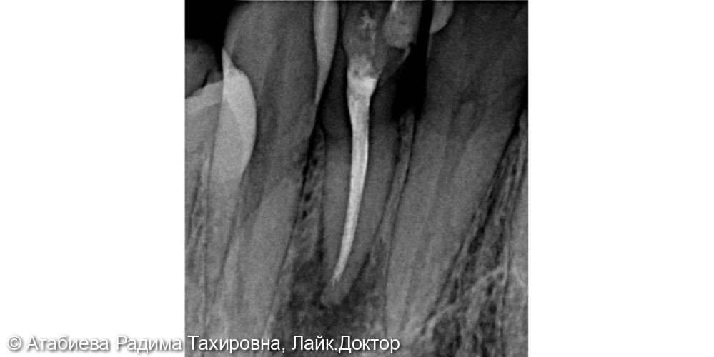 Эндодонтическое лечение 2.2 - фото №2