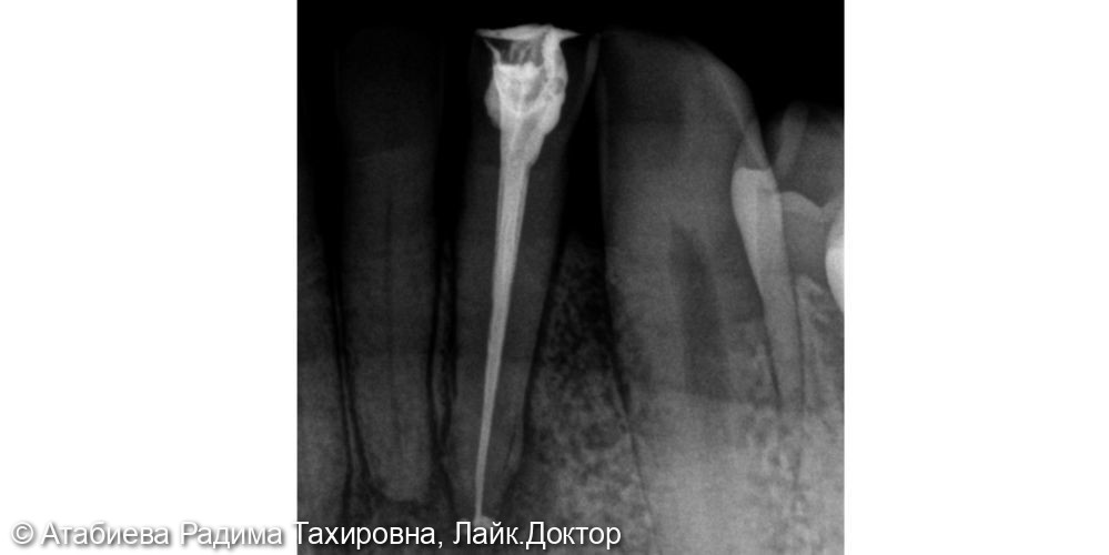 Эндодонтическое лечение 3.2 - фото №2