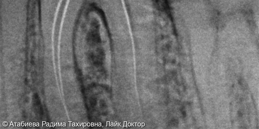 Эндодонтическое лечение 3.6 - фото №2