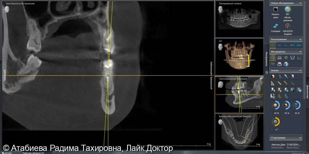 Эндодонтическое лечение - фото №1