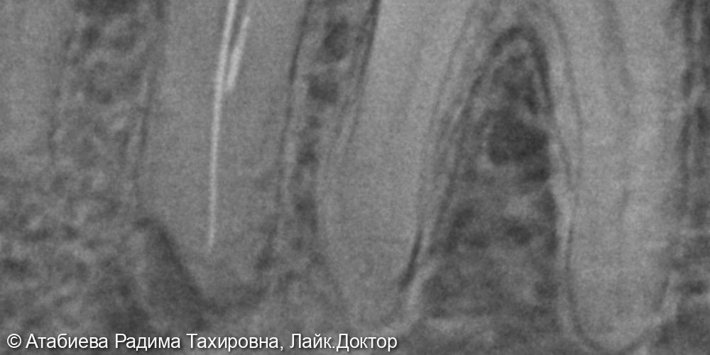 Эндодонтическое лечение - фото №2