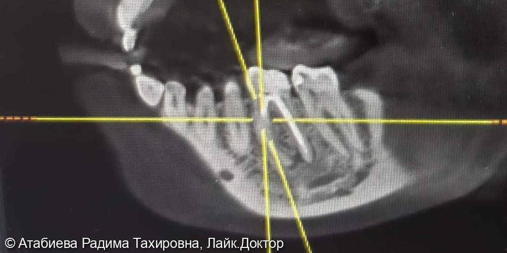 Лечение периодонтита зуб 3.6 - фото №4