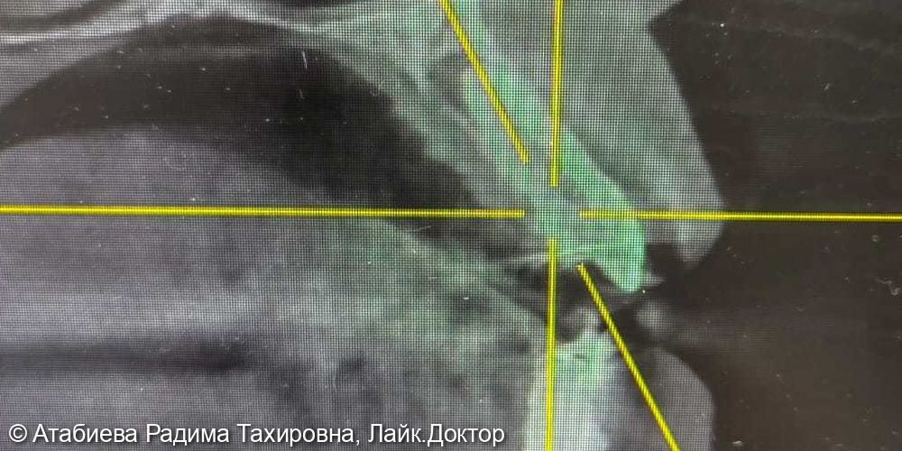 Лечение зуба 2.2 фото 2 · Вологда