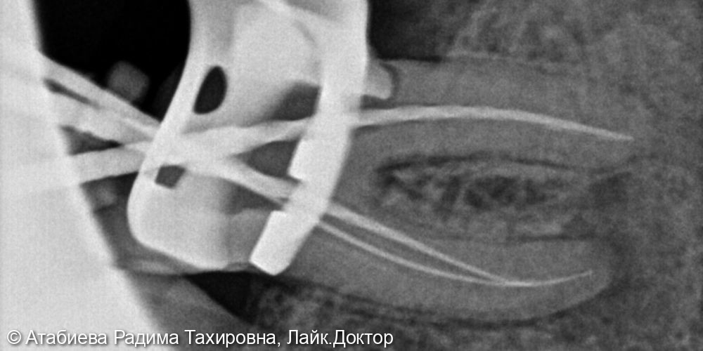 Эндодонтическое лечение фото 2 · Вологда