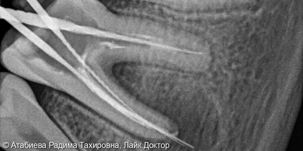 Эндодонтическое лечение фото 2 · Вологда
