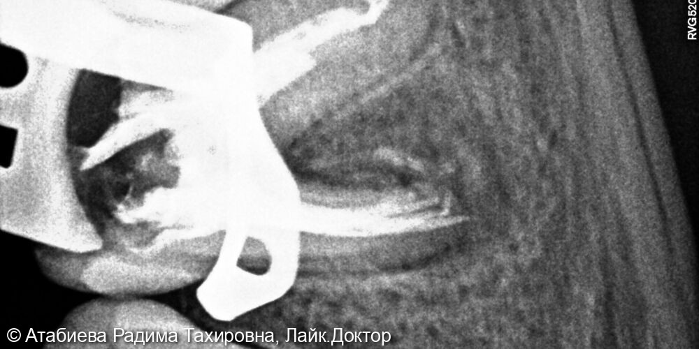 Эндодонтическое лечение фото 3 · Вологда