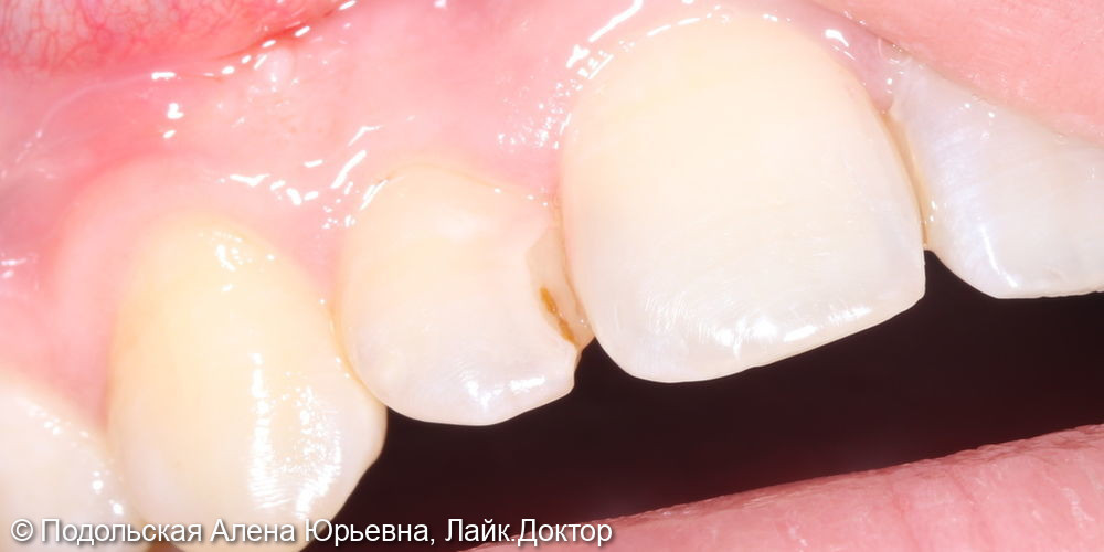 Лечение зуба 12 замена несостоятельной реставрации - фото №1