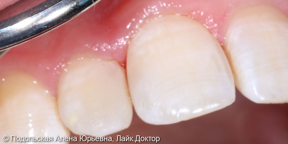 Лечение зуба 12 замена несостоятельной реставрации - фото №10