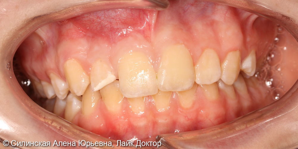 травма зуба 12 - фото №1