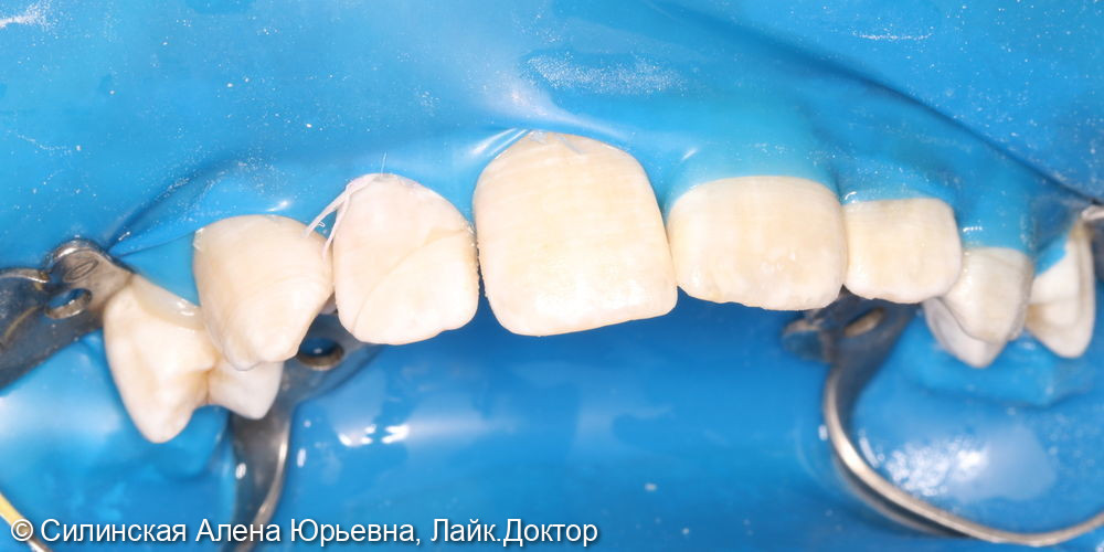травма зуба 12 - фото №3