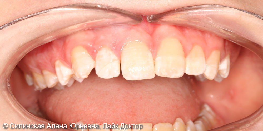 травма зуба 12 - фото №5