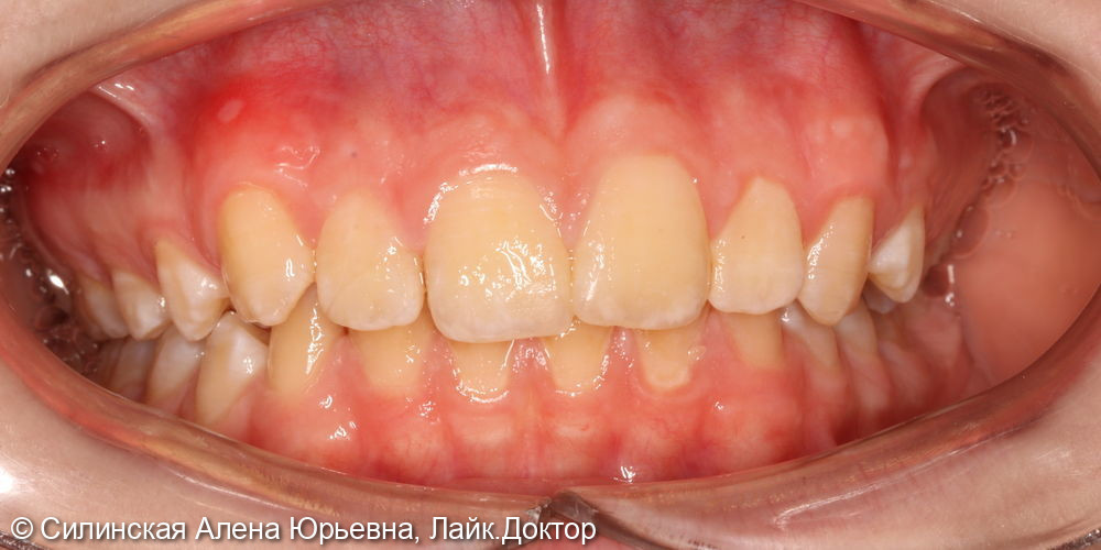 травма зуба 12 - фото №6