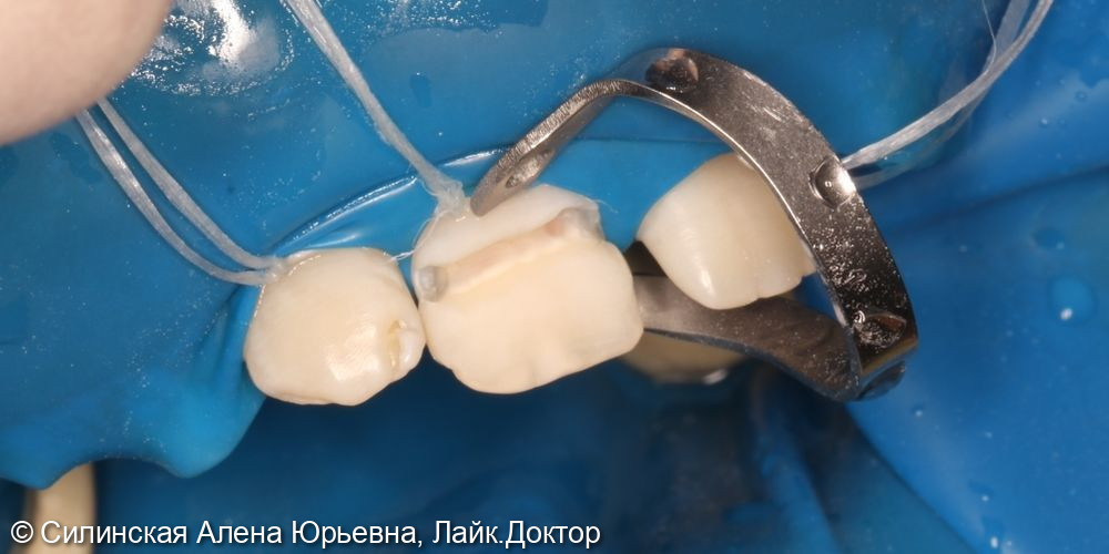 реставрация зуба 11 - фото №3
