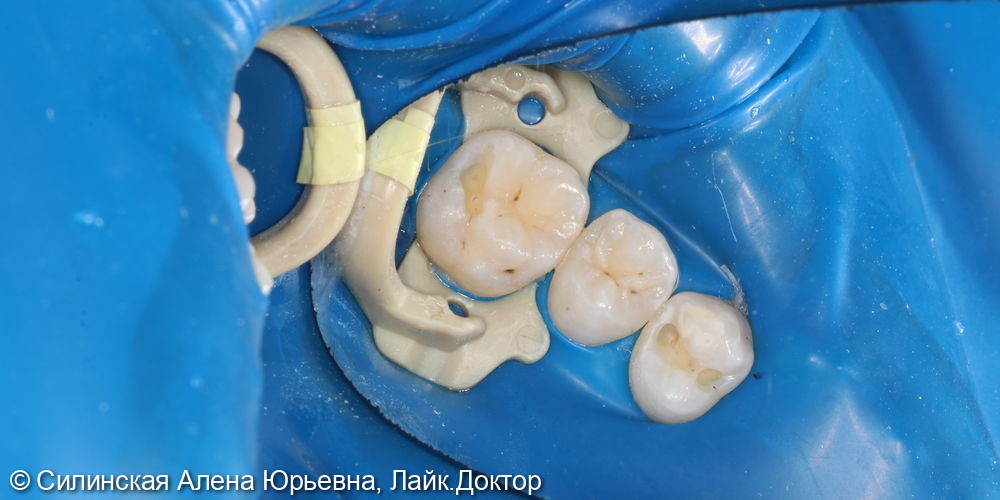 Лечение кариеса 16 и 14 - фото №3