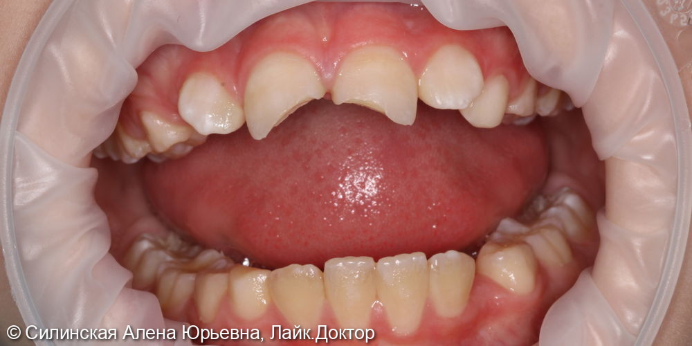 травма зуба 11 и 21 лечение в наркозе - фото №1