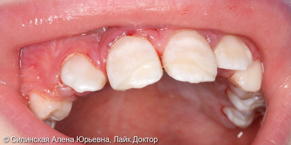 травма зуба 11 и 21 лечение в наркозе - фото №4