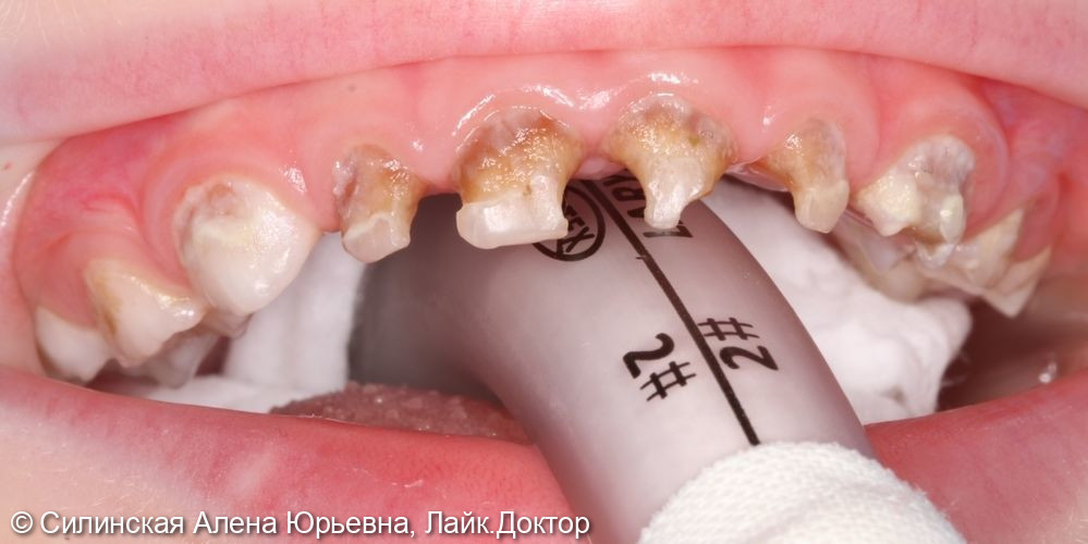 лечение зубов в наркозе - фото №2