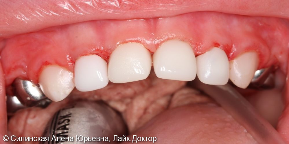 лечение зубов в наркозе - фото №5