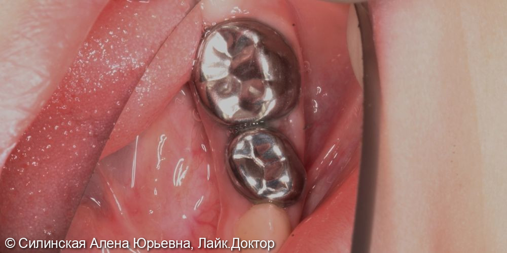 лечение зубов в наркозе - фото №13