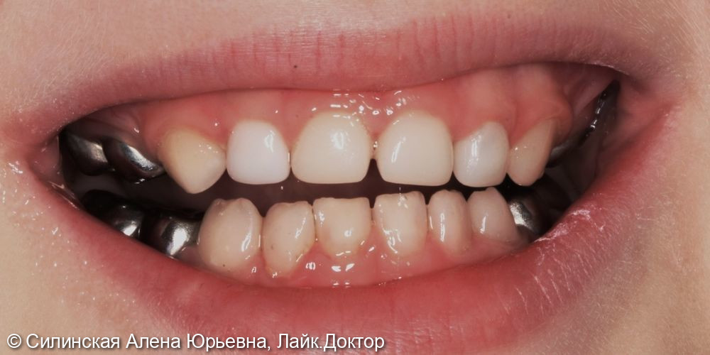 лечение зубов в наркозе - фото №14