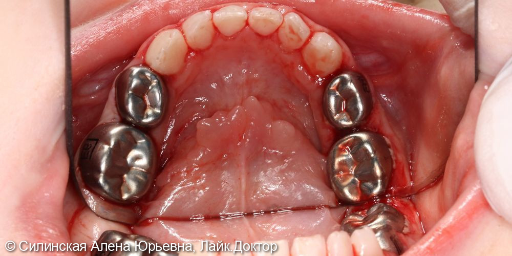 лечение зубов в наркозе - фото №9