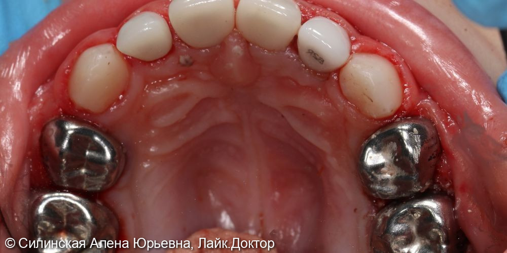 лечение зубов в наркозе - фото №6