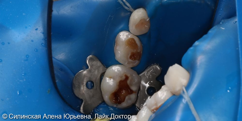 лечение зубов в наркозе - фото №8