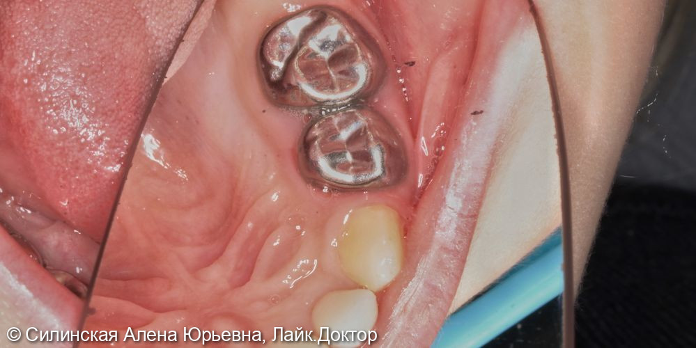 лечение зубов в наркозе - фото №11