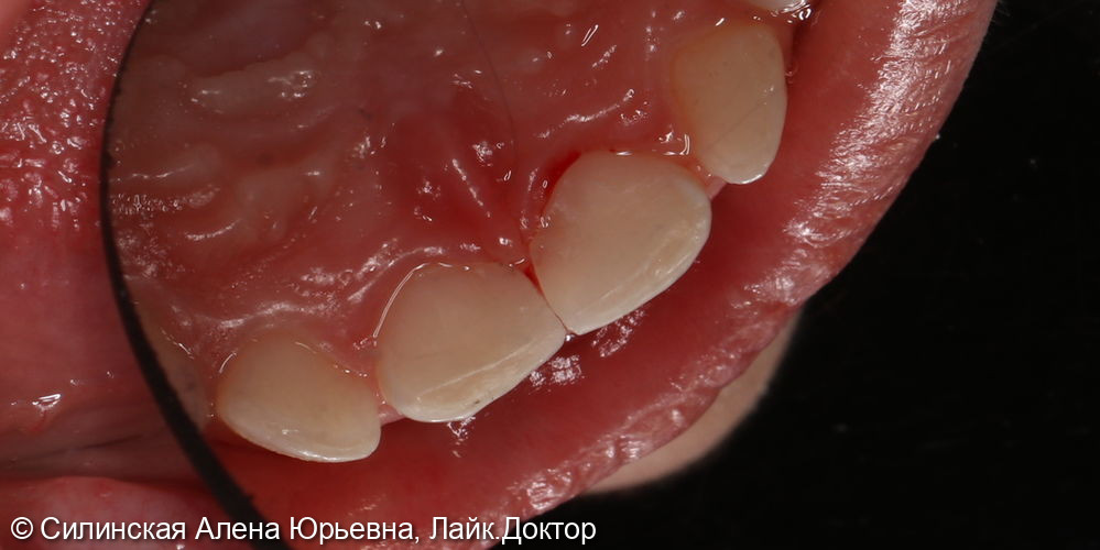 лечение кариеса 51 и 61 - фото №7