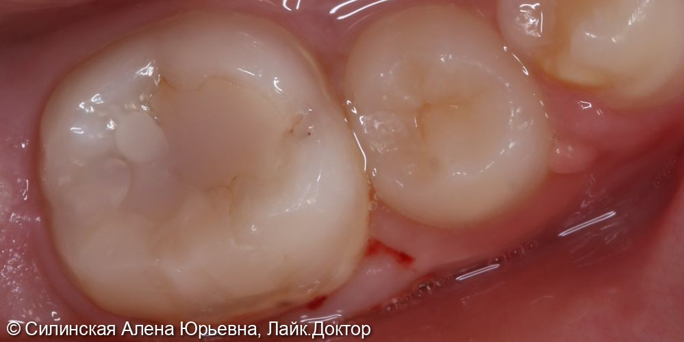 Лечение глубокого кариеса 36 зуба - фото №1