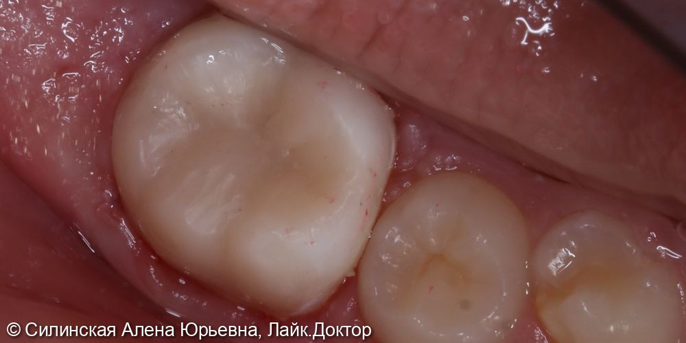 Лечение глубокого кариеса 36 зуба - фото №6