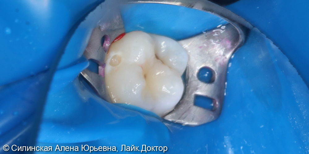 лечение кариеса 16 зуба - фото №2