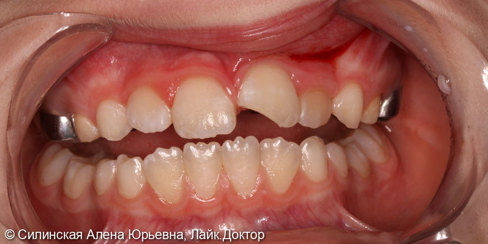 Травма зуба 21 - фото №1