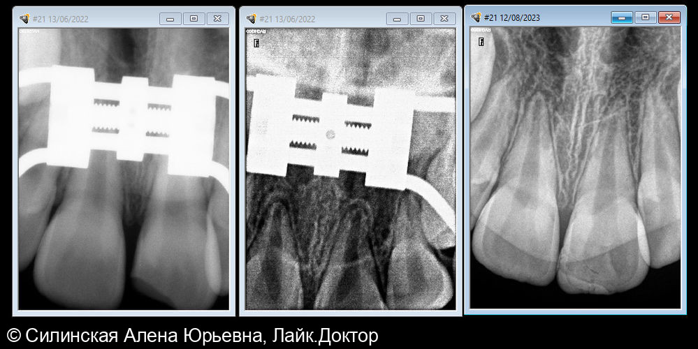 Травма зуба 21 - фото №6