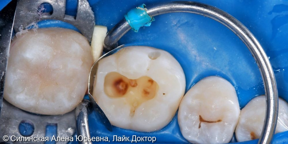 Лечение кариеса 47 и 46 - фото №7