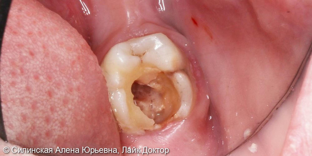 Лечение хронического периодонтита зуба 36 - фото №1