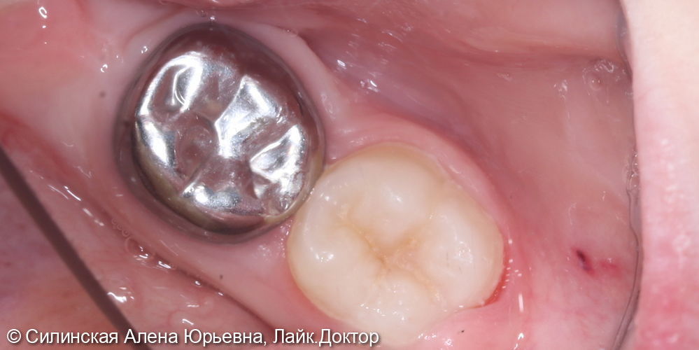 Лечение хронического периодонтита зуба 36 - фото №6