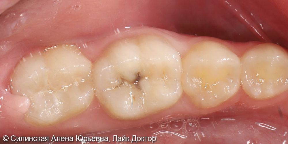 Лечение хронического апикального периодонтита зуба 46 - фото №1