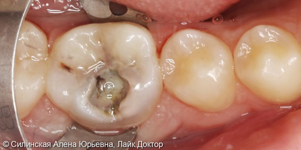 Лечение обострения хронического апикального периодонтита 36 зуба - фото №1