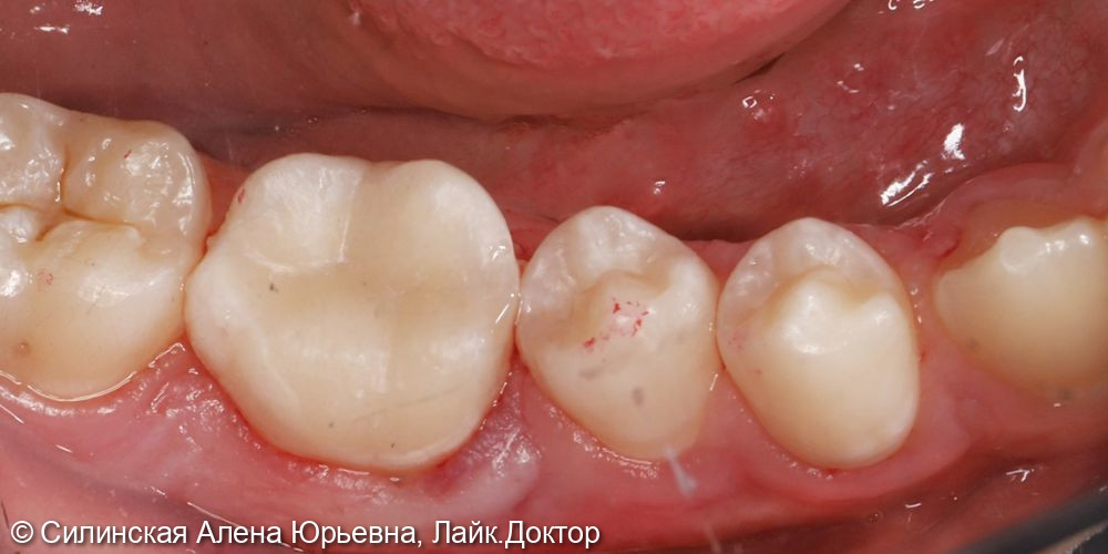 Лечение обострения хронического апикального периодонтита 36 зуба - фото №12
