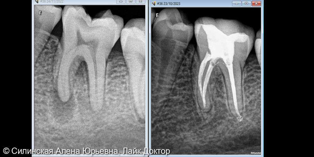 Лечение обострения хронического апикального периодонтита 36 зуба - фото №11