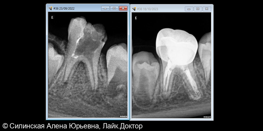 Лечение хронического периодонтита зуба 36 - фото №5