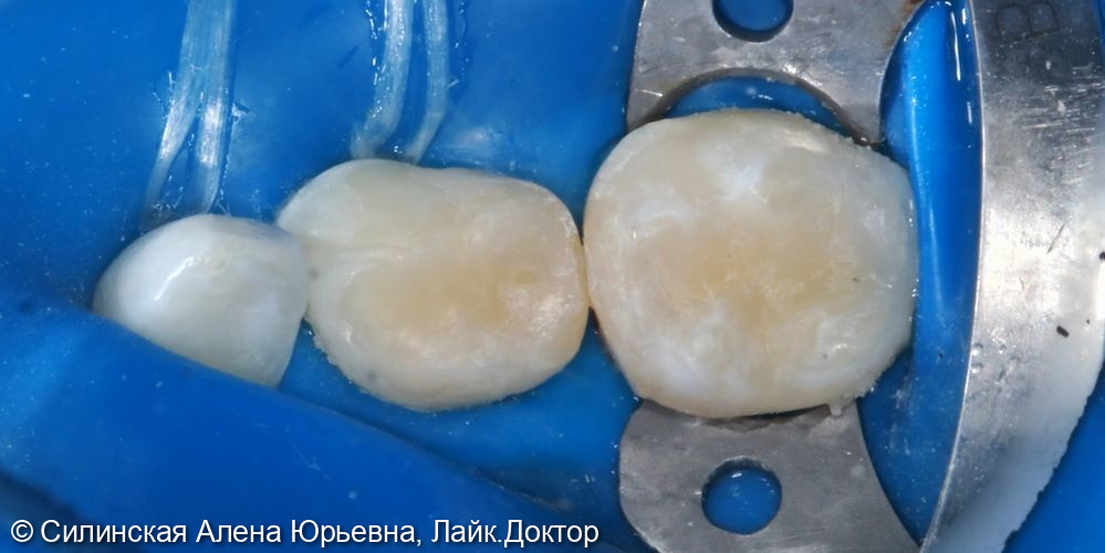 Лечение кариеса 75 и обратилось пульпита зуба 74 - фото №5