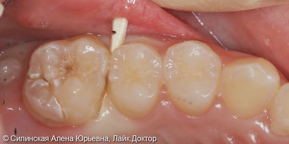 Лечение кариеса зуба 26 - фото №1