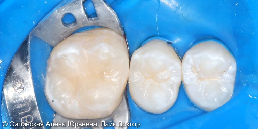 Лечение кариеса зуба 26 - фото №4