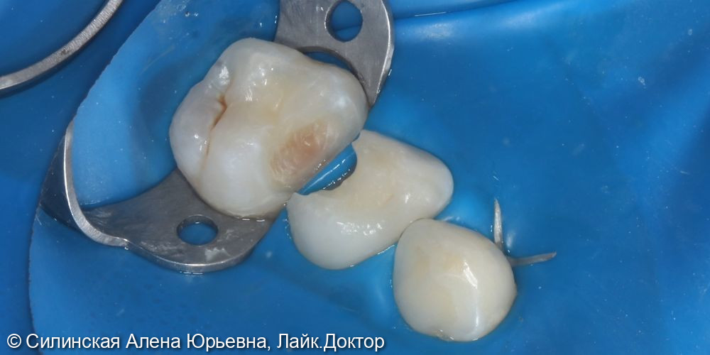 Лечение обратимого пульпита зуба 64,65 - фото №2
